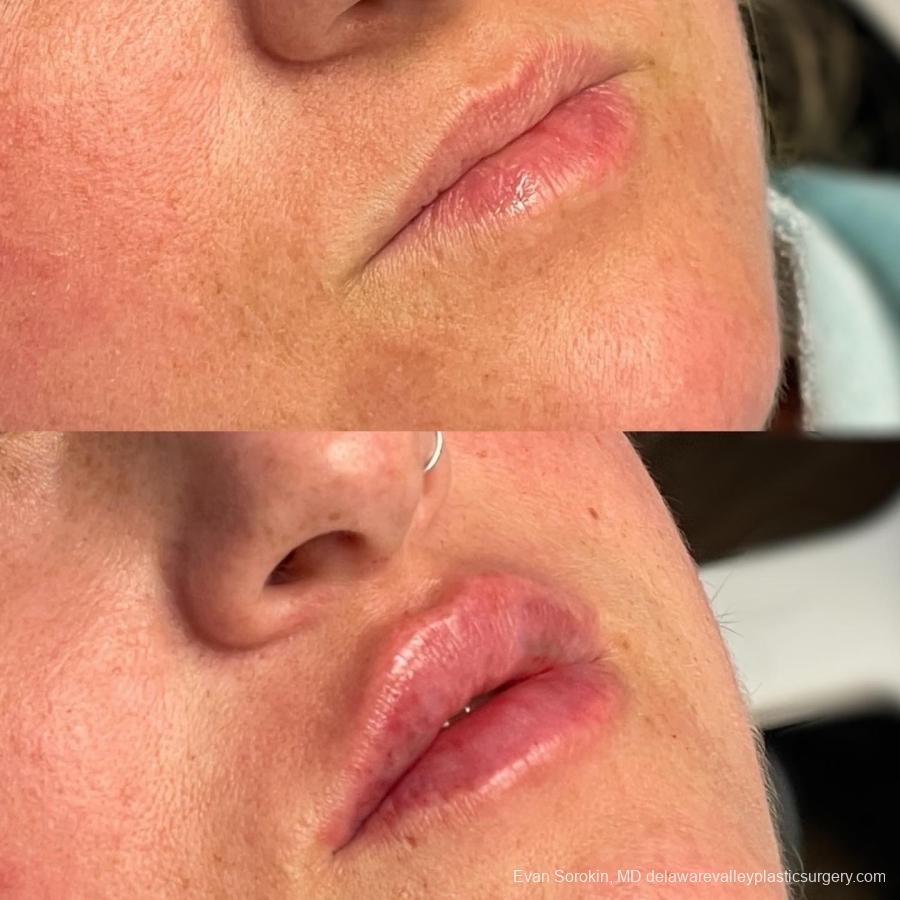 Lip Augmentation: Patient 61 - Before and After 2