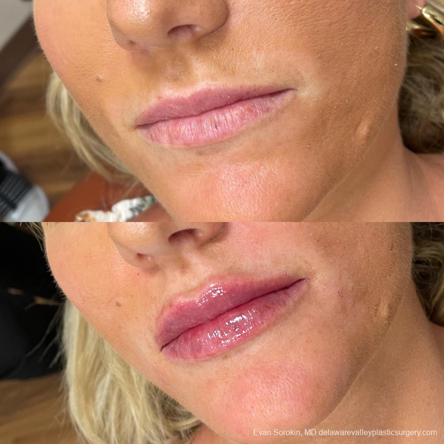 Lip Filler: Patient 38 - Before and After 3