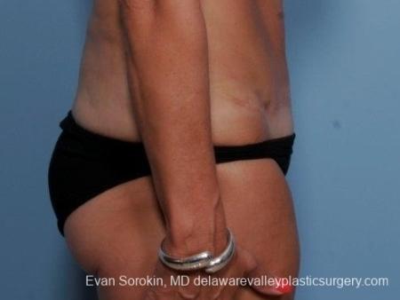 Philadelphia Abdominoplasty 8682 - After Image 4