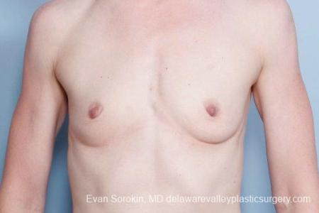 Philadelphia Breast Augmentation 9169 - Before Image 1