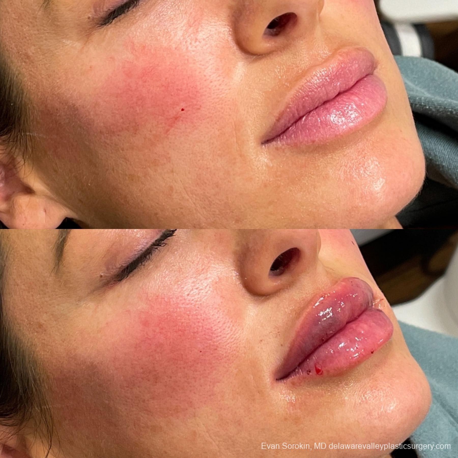 Lip Filler: Patient 50 - Before and After 2