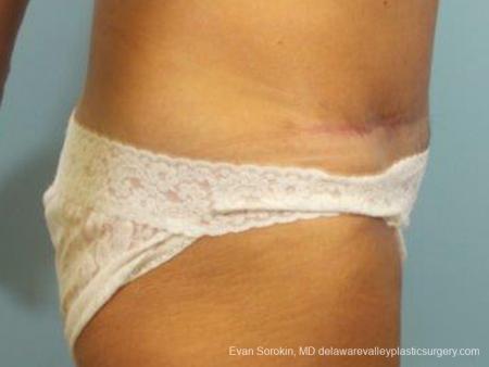 Philadelphia Abdominoplasty 9464 - After Image 3