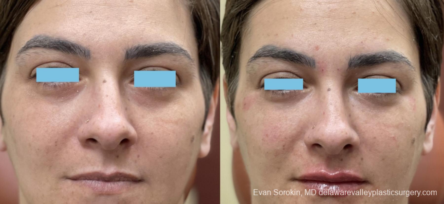 Fillers: Patient 10 - Before and After 1
