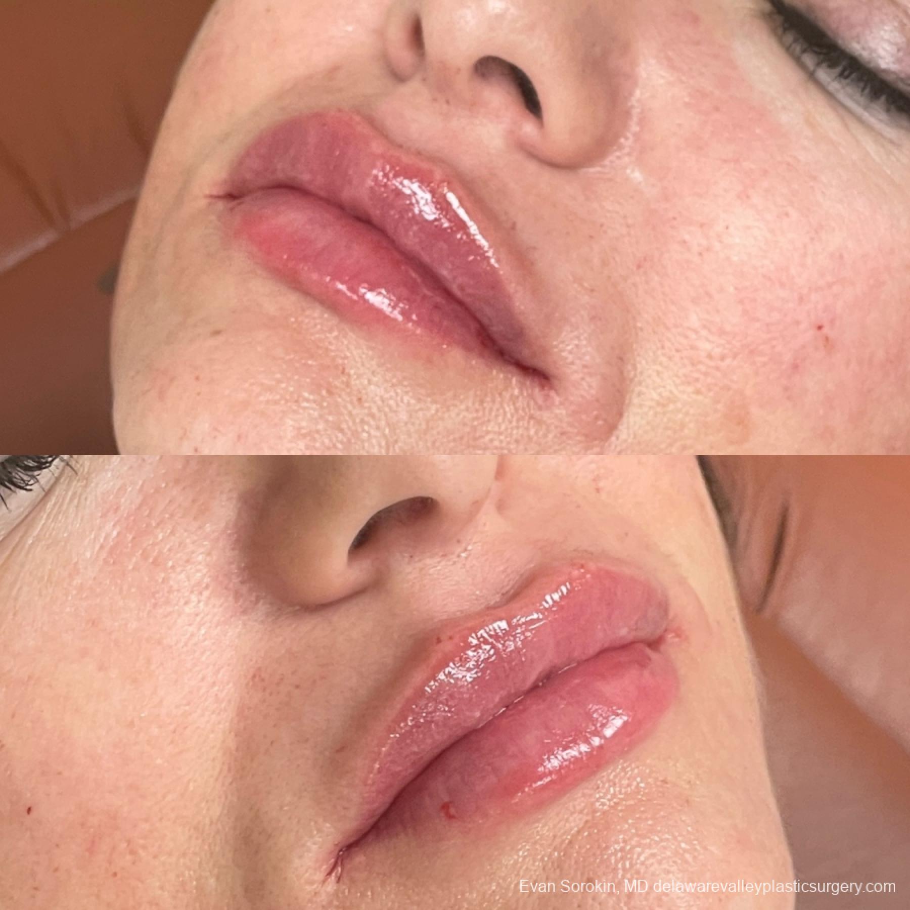 Lip Augmentation: Patient 5 - Before and After 1