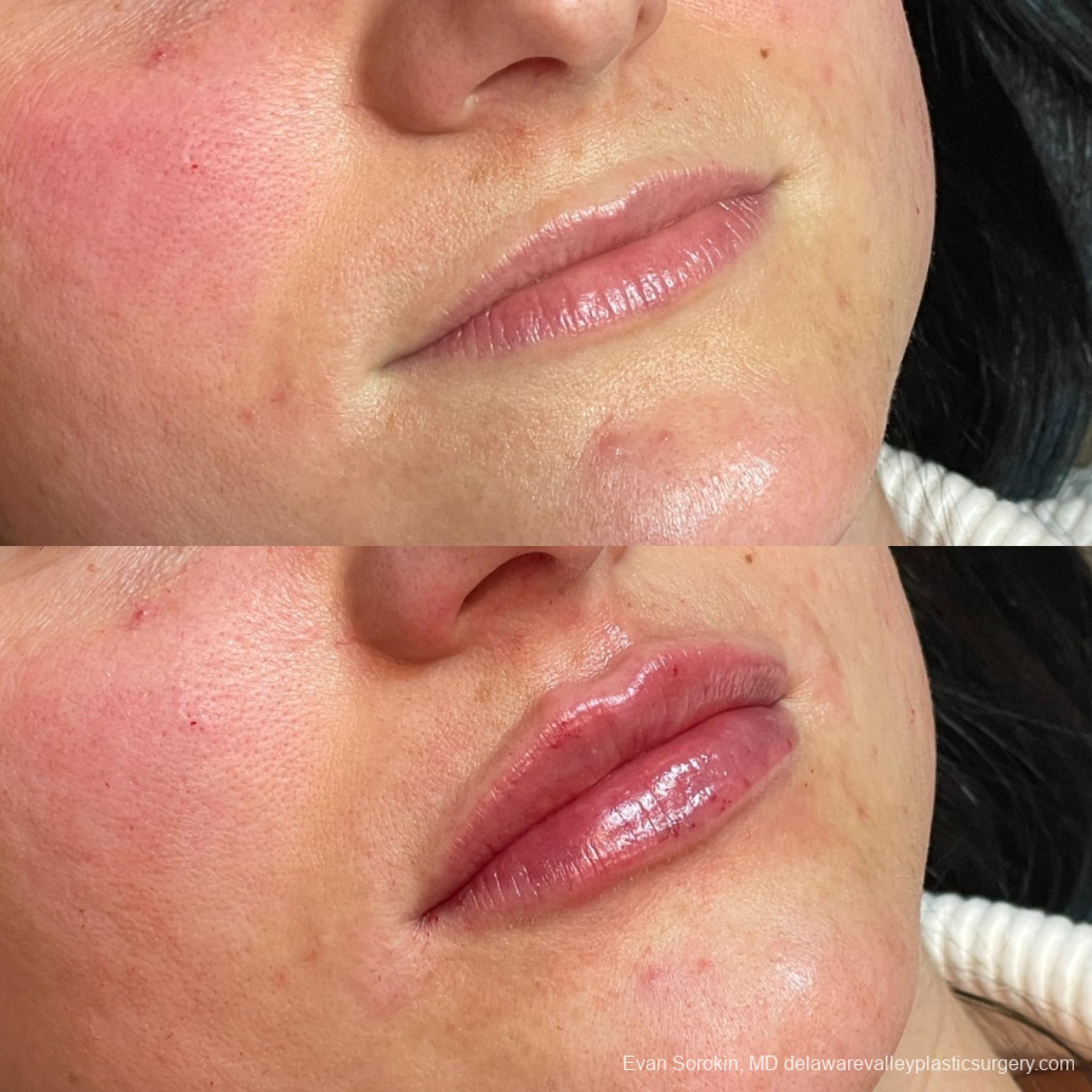 Fillers: Patient 40 - Before and After 2