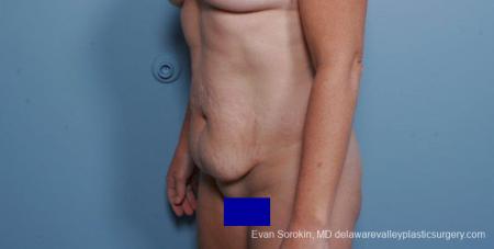 Philadelphia Abdominoplasty 9315 - Before Image 2