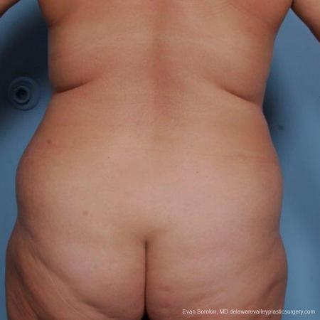 Philadelphia Liposuction 9481 - Before and After Image 4