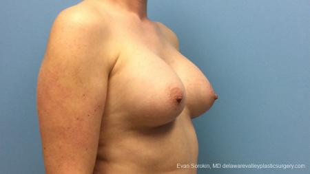 Philadelphia Breast Augmentation 13181 - After Image 2