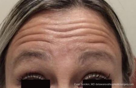 BOTOX® Cosmetic: Patient 4 - Before Image 1