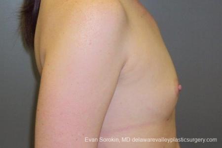 Philadelphia Breast Augmentation 8669 - Before Image 4
