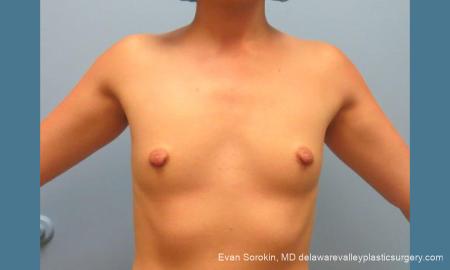 Philadelphia Breast Augmentation 10193 - Before Image 1