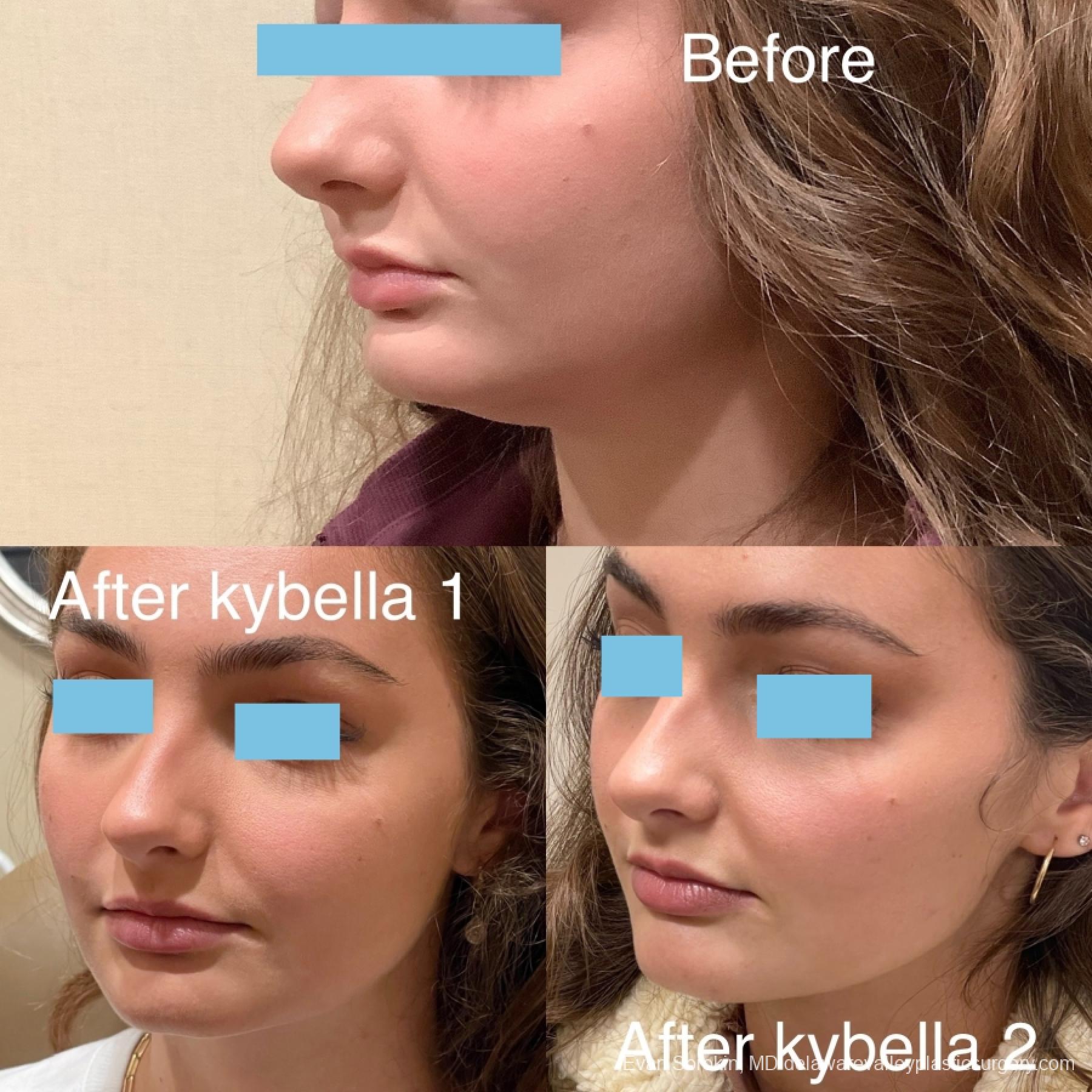 Kybella: Patient 1 - Before and After 3