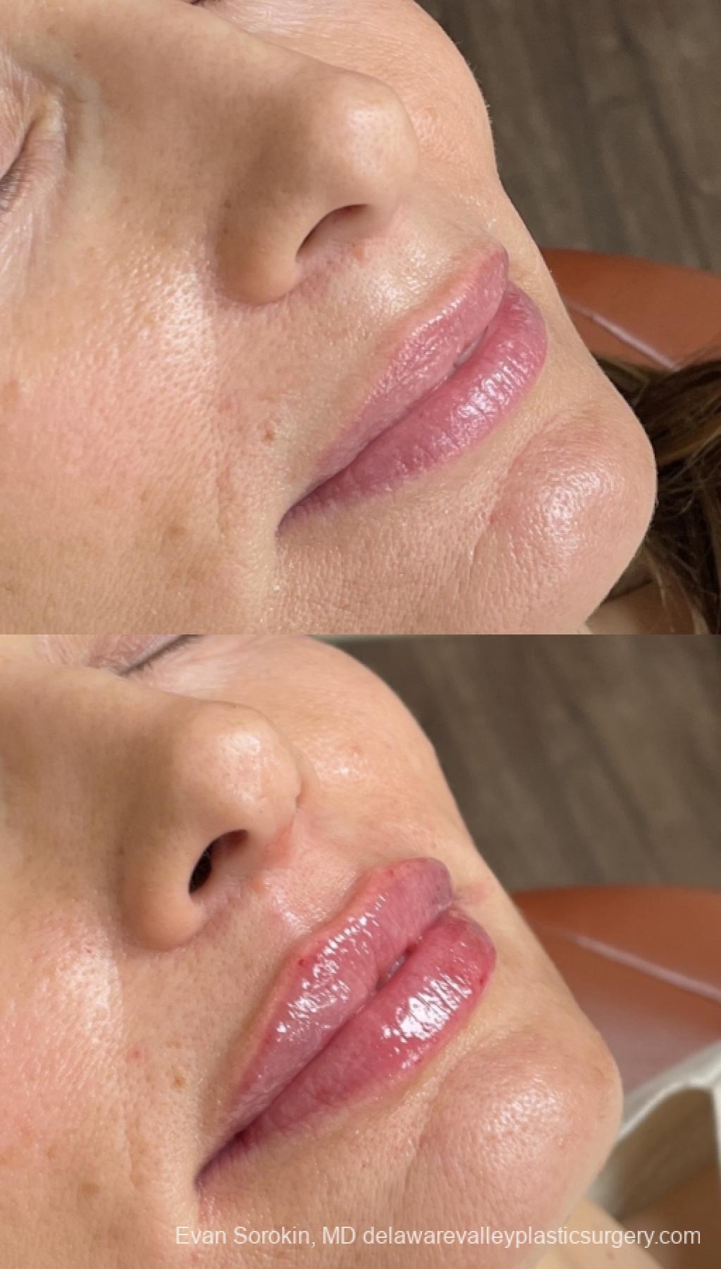 Lip Augmentation: Patient 60 - Before and After 2