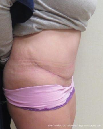Philadelphia Abdominoplasty 9267 - After Image 3