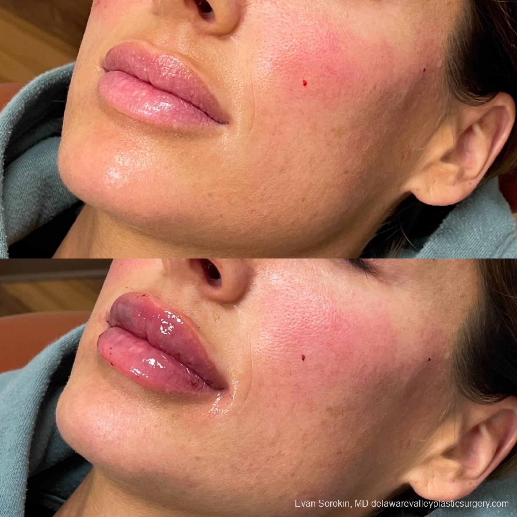 Lip Augmentation: Patient 49 - Before and After 3