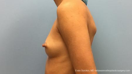 Philadelphia Breast Augmentation 13176 - Before and After Image 5