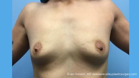 Breast Augmentation: Patient 137 - Before Image 1