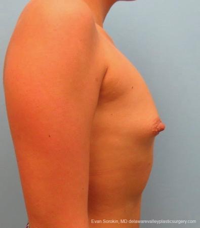 Philadelphia Breast Augmentation 8826 - Before Image 4