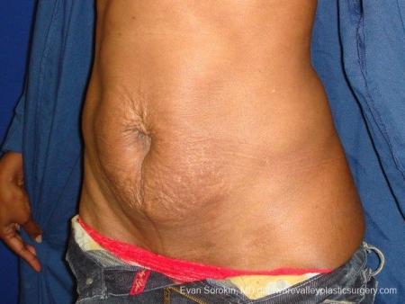 Philadelphia Abdominoplasty 8707 - Before Image 2