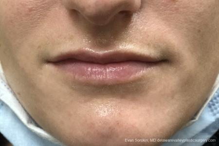 Lip Filler: Patient 11 - Before Image 1