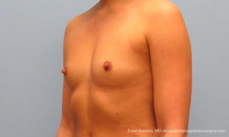 Philadelphia Breast Augmentation 9410 - Before Image 4