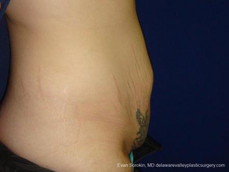 Philadelphia Abdominoplasty 9473 - Before Image 3