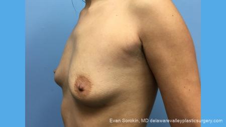 Breast Augmentation: Patient 137 - Before Image 2