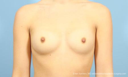 Philadelphia Breast Augmentation 8641 - Before Image 1