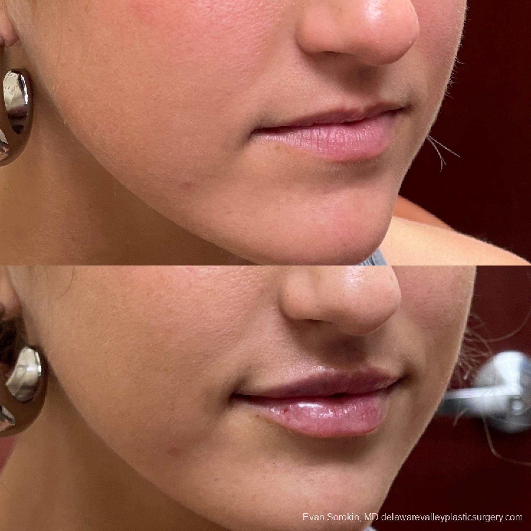Lip Augmentation: Patient 13 - Before and After 2