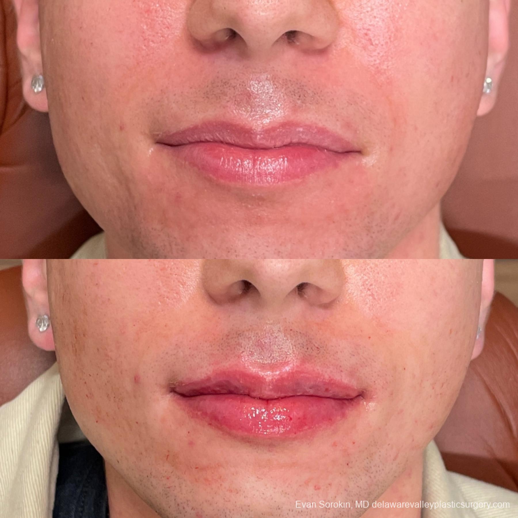 Fillers: Patient 39 - Before and After 