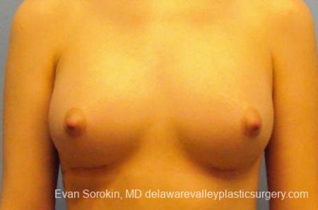 Philadelphia Breast Augmentation 10113 - After Image 1