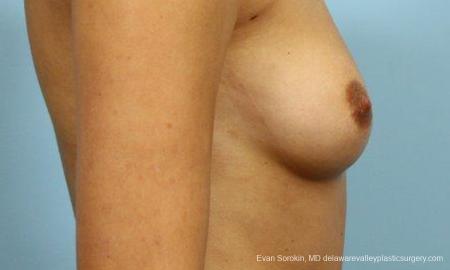 Philadelphia Breast Augmentation 9195 - Before Image 3