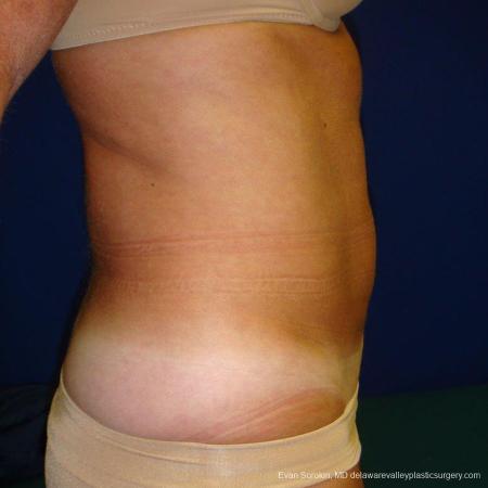 Philadelphia Liposuction 9488 - After Image 3