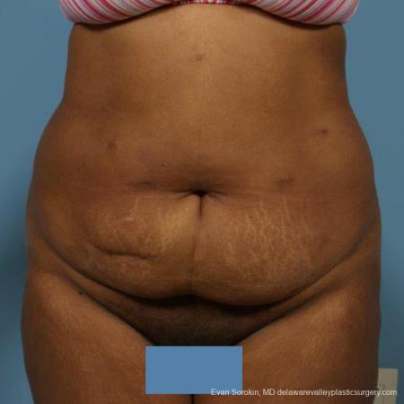 Philadelphia Abdominoplasty 9472 - Before Image 1