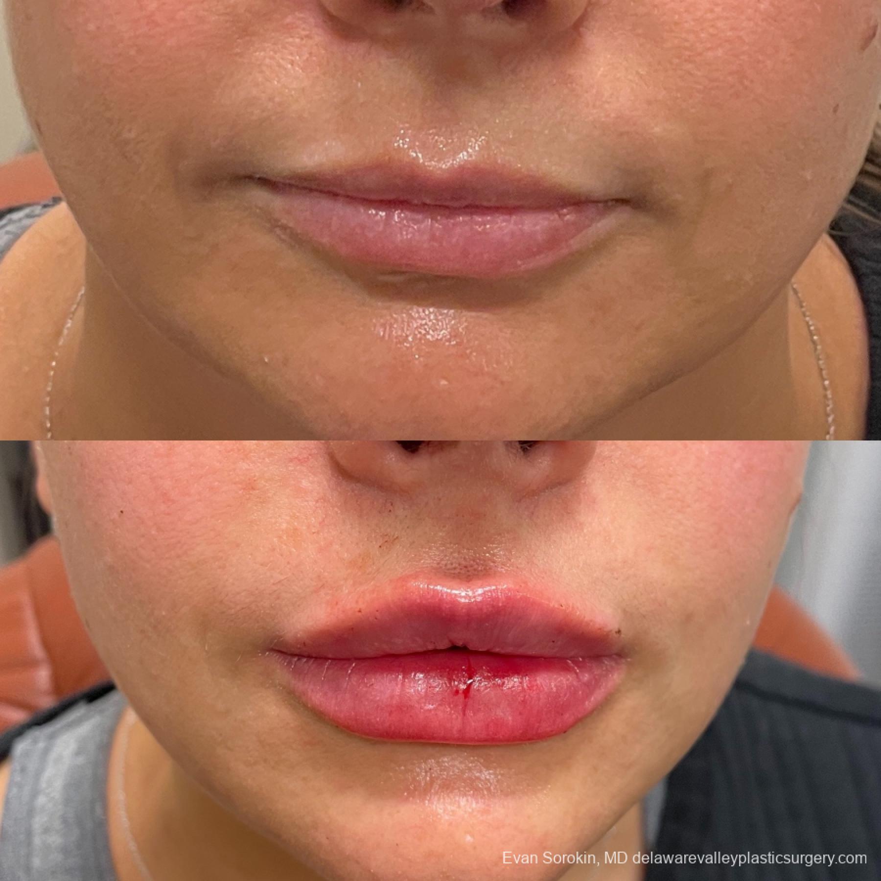 Lip Augmentation: Patient 25 - Before and After 