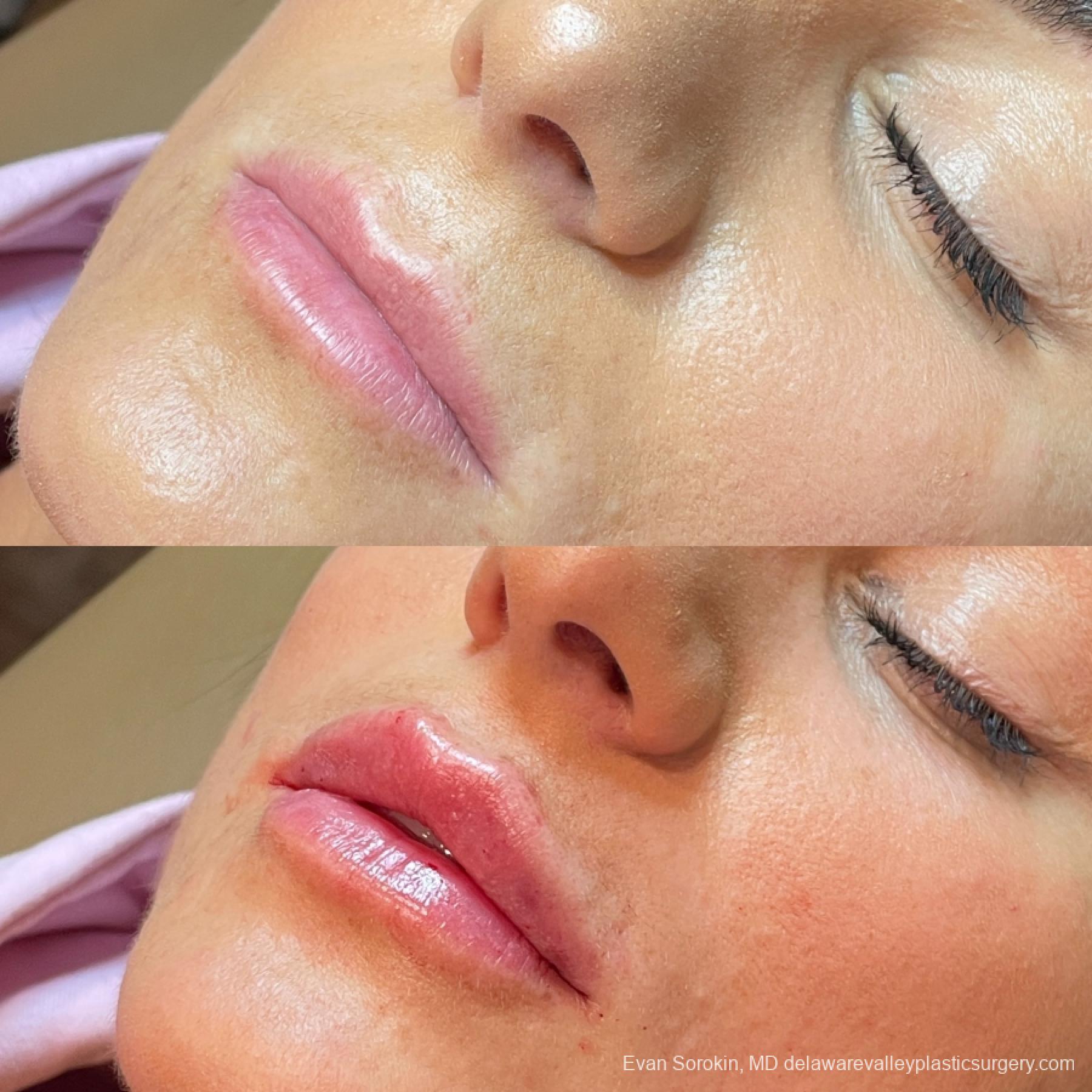 Lip Augmentation: Patient 6 - Before and After 3