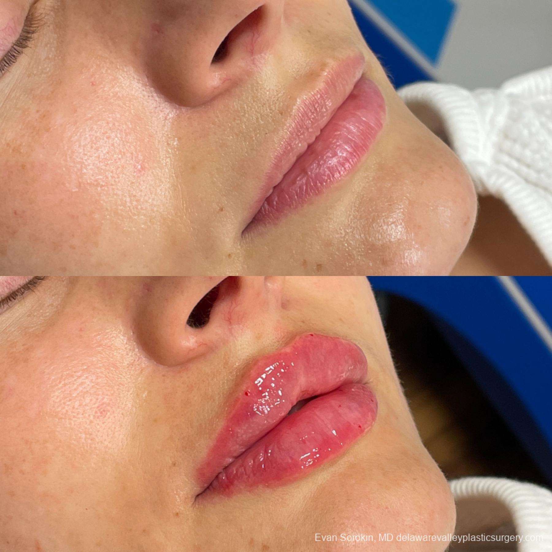 Fillers: Patient 31 - Before and After 2