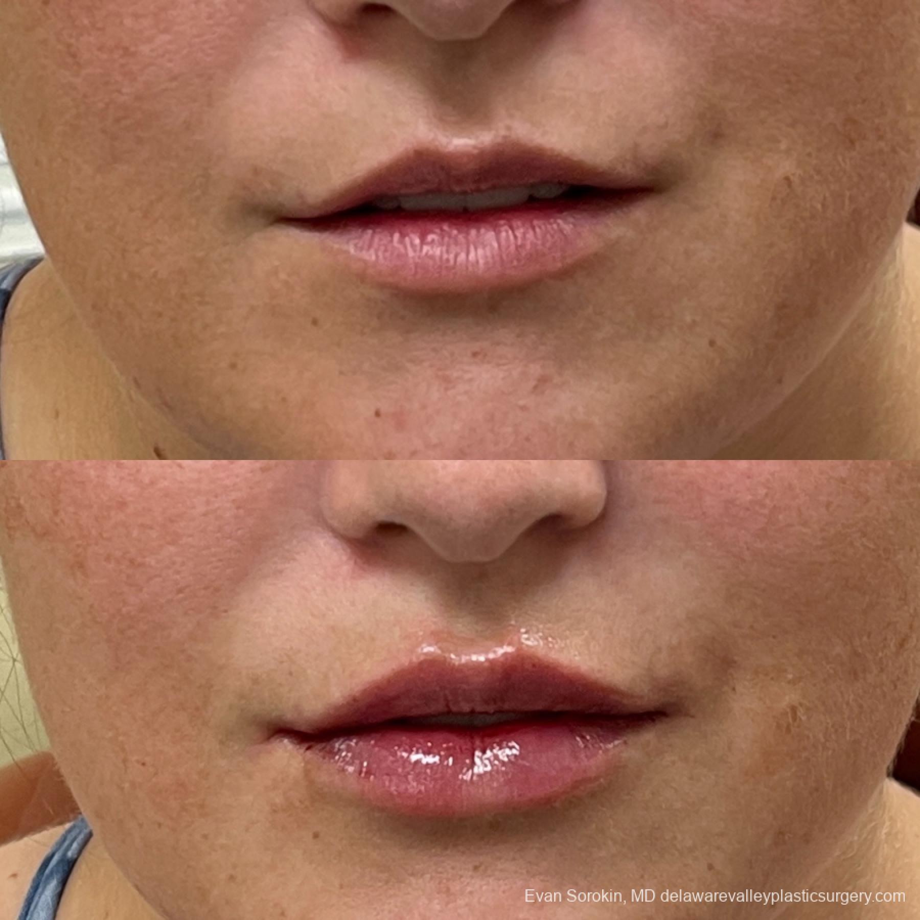 Lip Filler: Patient 12 - Before and After 1