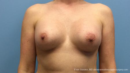 Philadelphia Breast Augmentation 13181 - After Image 1
