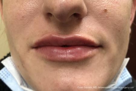 Lip Filler: Patient 11 - After Image 1