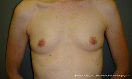 Philadelphia Breast Augmentation 9180 - Before Image 1