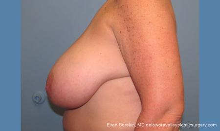Philadelphia Breast Reduction 10118 - Before and After Image 5
