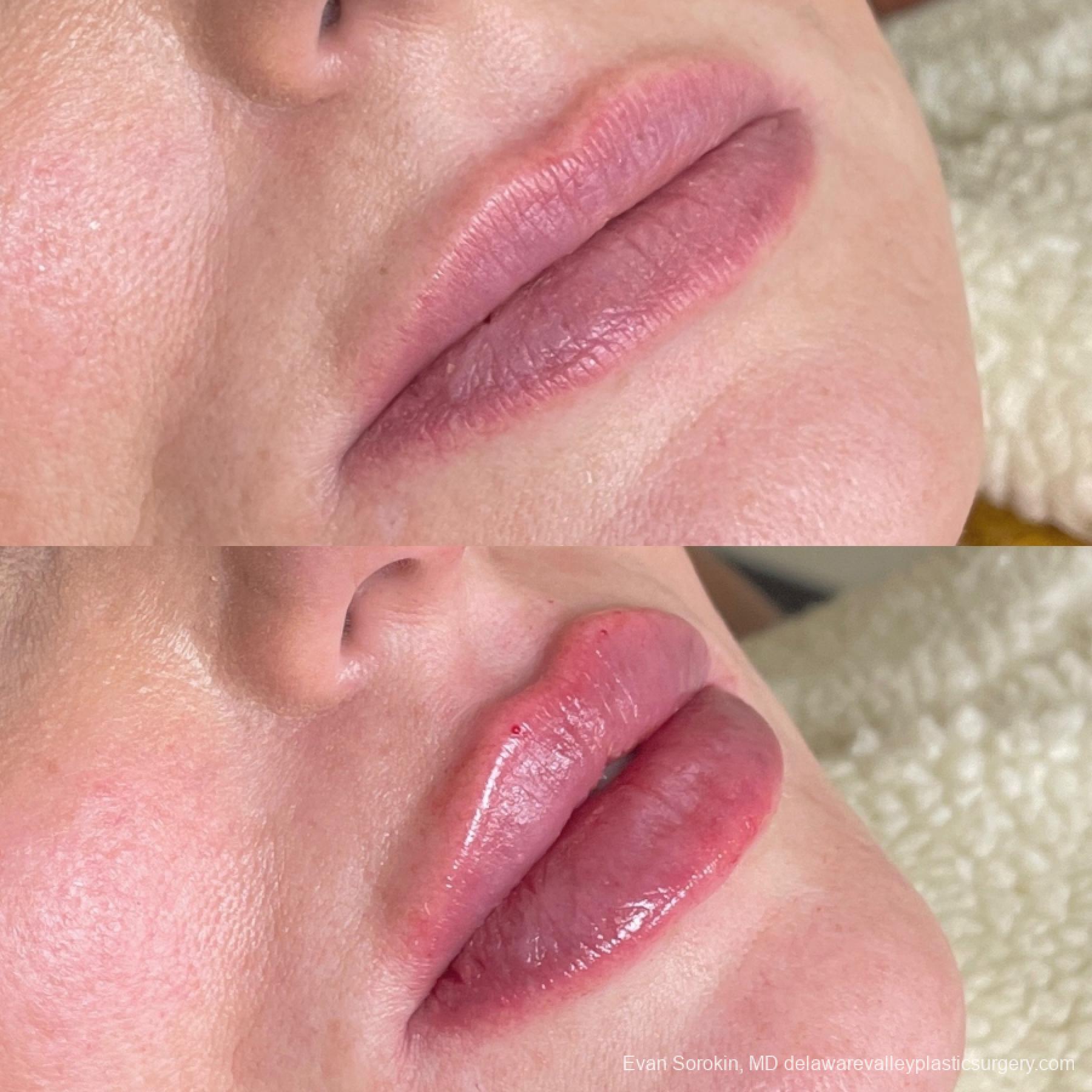 Lip Filler: Patient 63 - Before and After 2
