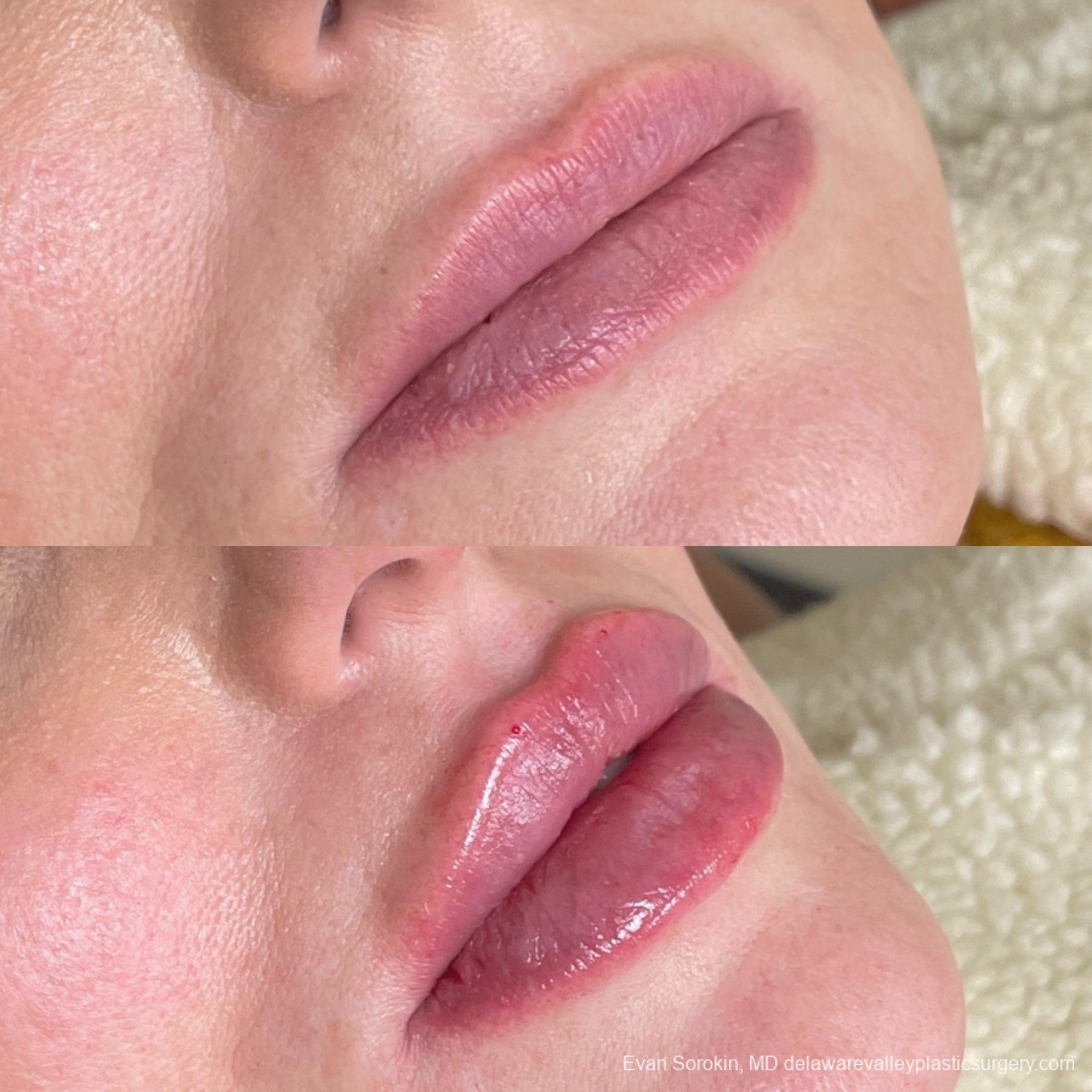 Lip Filler: Patient 62 - Before and After 2