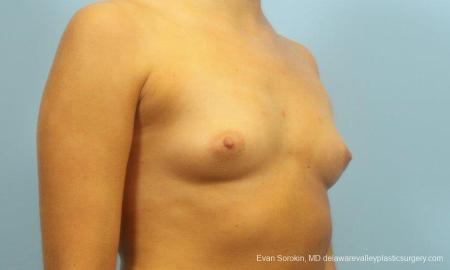 Philadelphia Breast Augmentation 9183 - Before Image 2