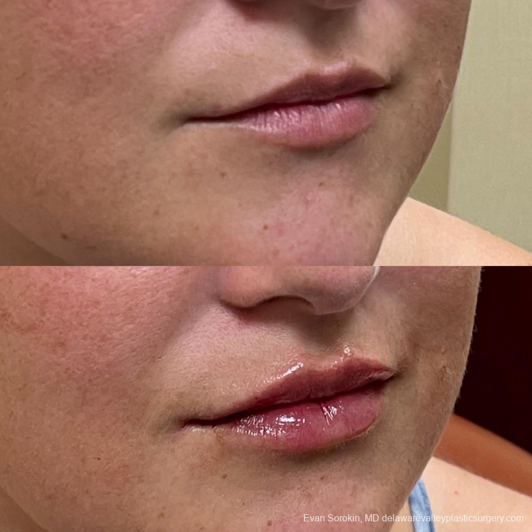 Lip Filler: Patient 12 - Before and After 2