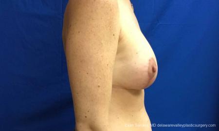 Philadelphia Breast Lift and Augmentation 10814 - After Image 3