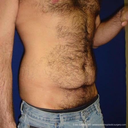 Philadelphia Abdominoplasty 9468 - Before Image 2