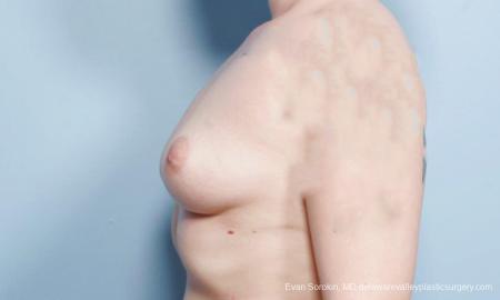 Philadelphia Breast Augmentation 9419 - Before and After Image 5