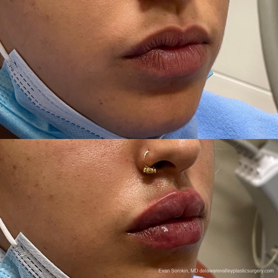 Lip Filler: Patient 4 - Before and After 2